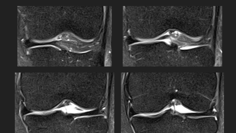 Figure 3 for case meniscofemoral ligament ( RID2806 )